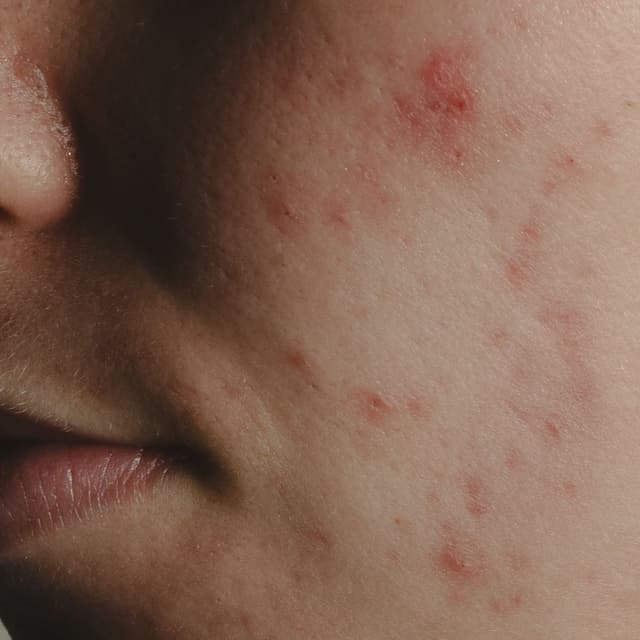 ACNE PEEL/TREATMENT PACKAGE at Honeyveil Esthetics in Columbus, IN